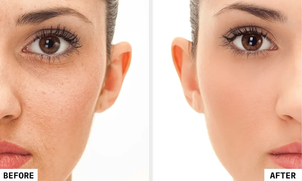 chemical peel in kolkata