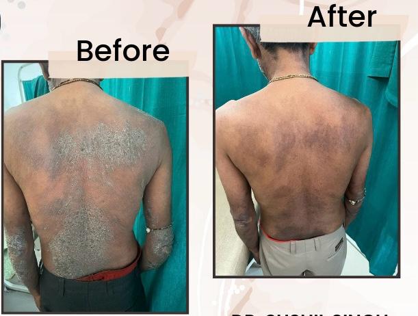 Before-after results of dermatological back skin treatment