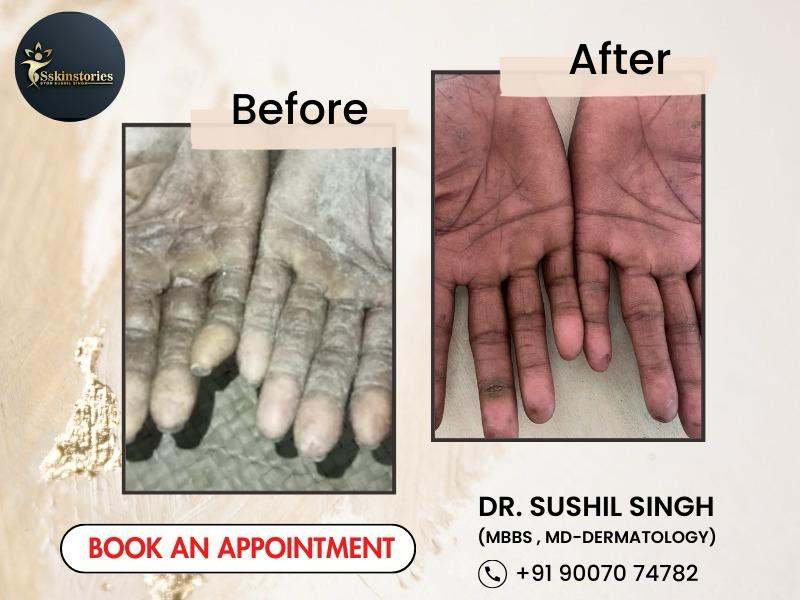 Before-and-after comparison of severely dry, peeling hands treatment.