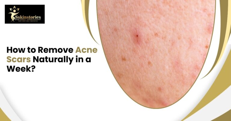 Acne Scars