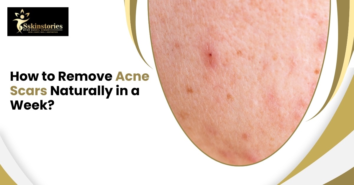 Acne Scars