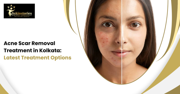 Acne Scar Removal Treatment in Kolkata