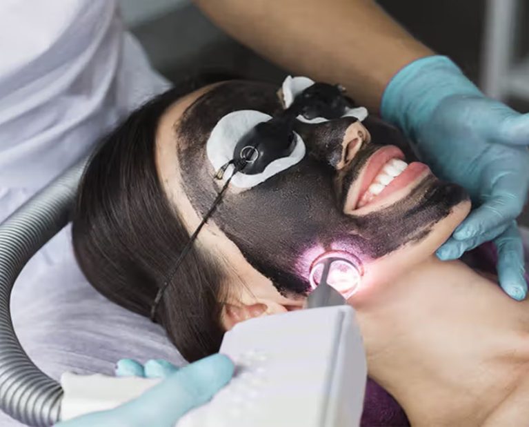 Laser_Carbon_Peel_732x549-thumbnail-732x549 (1)